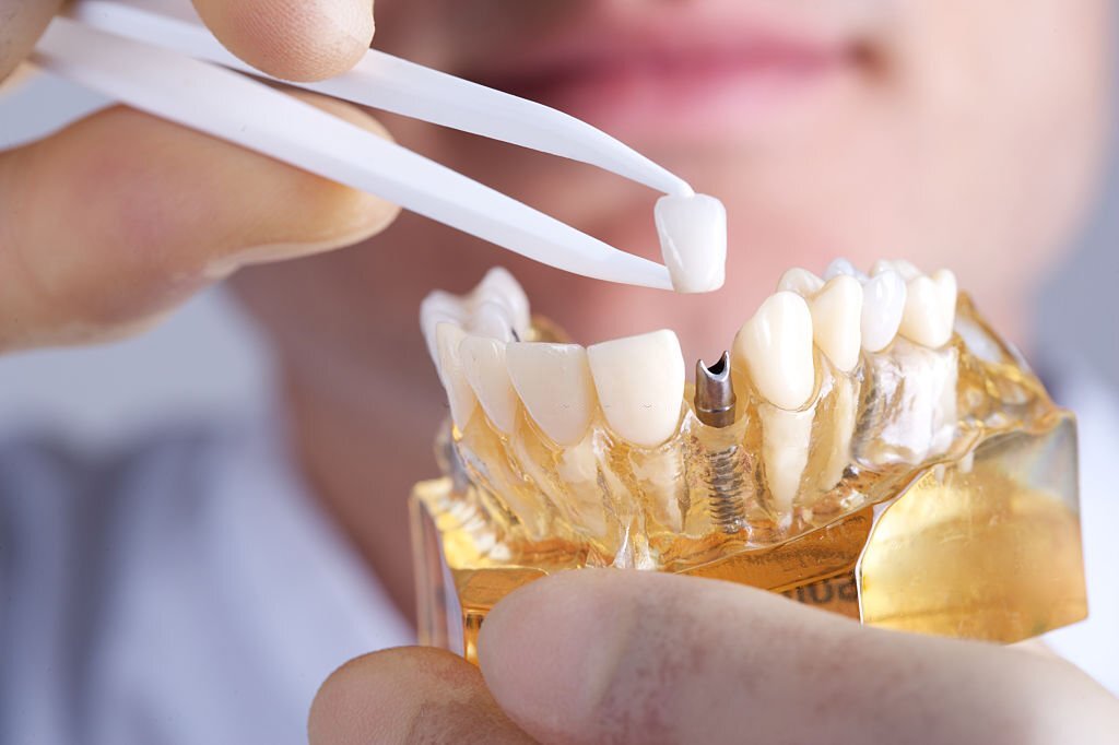 Health Benefits Of Dental Implants
