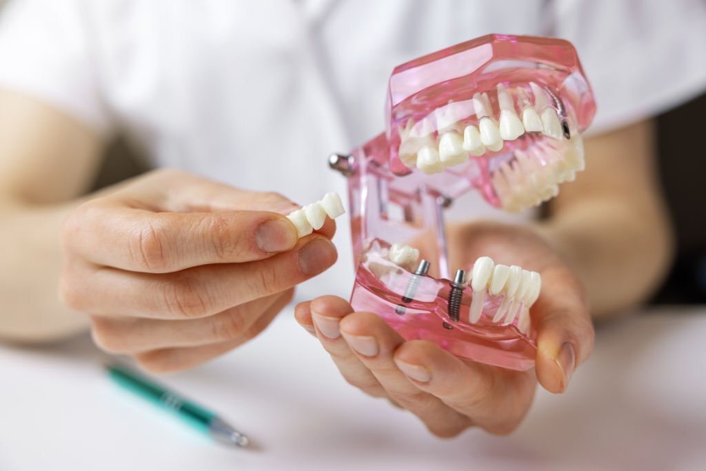 How To Floss Around A Dental Bridge