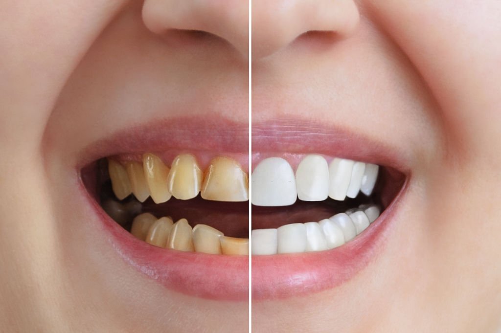 Real-Life Cosmetic Dentistry Transformations