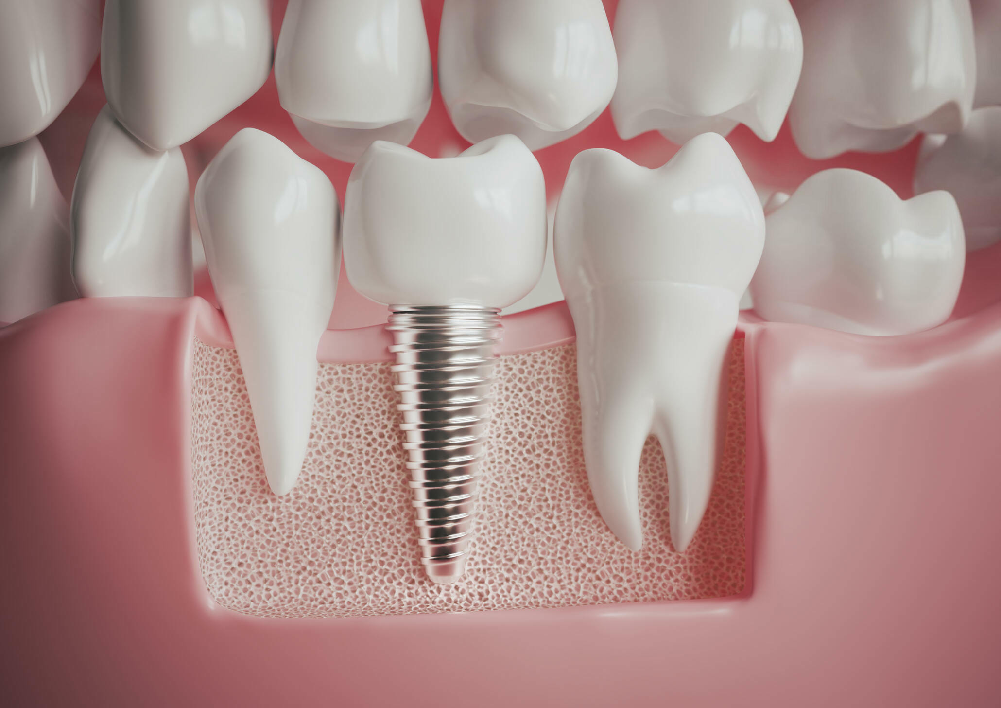 Implant Dentistry By Cosmetic Dentist in Gallup, NM: Everything You Need to Know!_FI