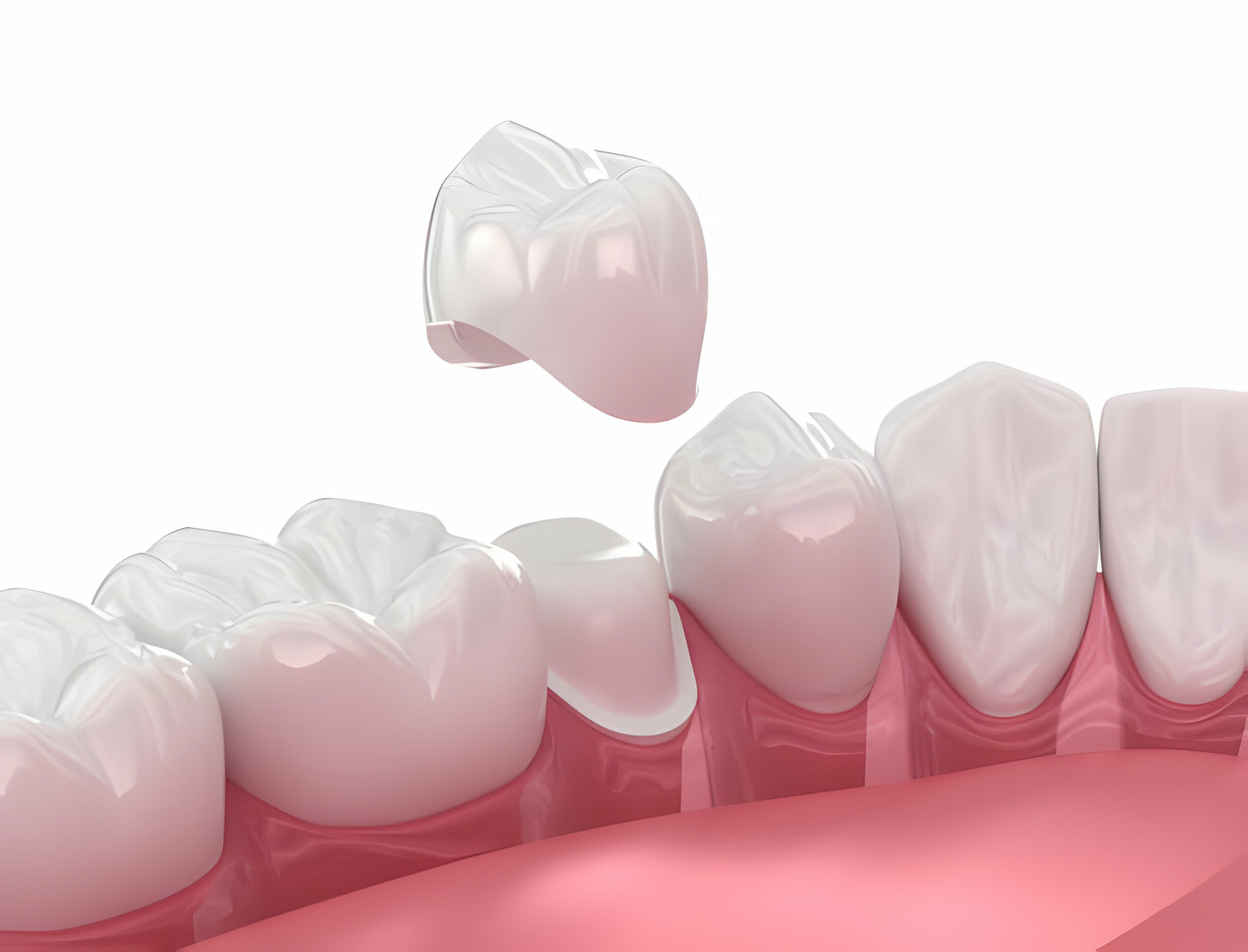 Know Everything About Different Types of Dental Crowns_FI