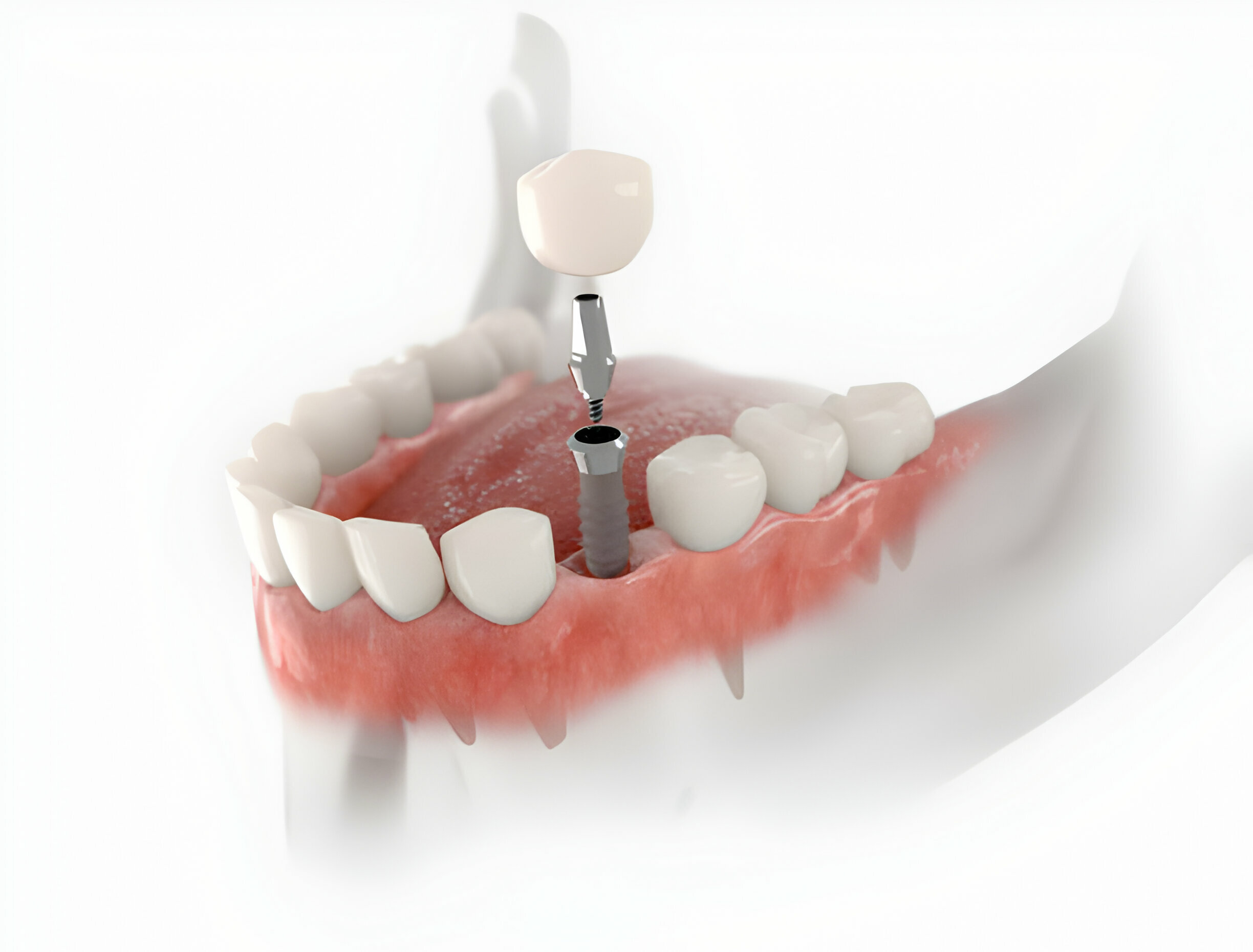 Everything You Need To Know About Dental Implants In Summerville_FI