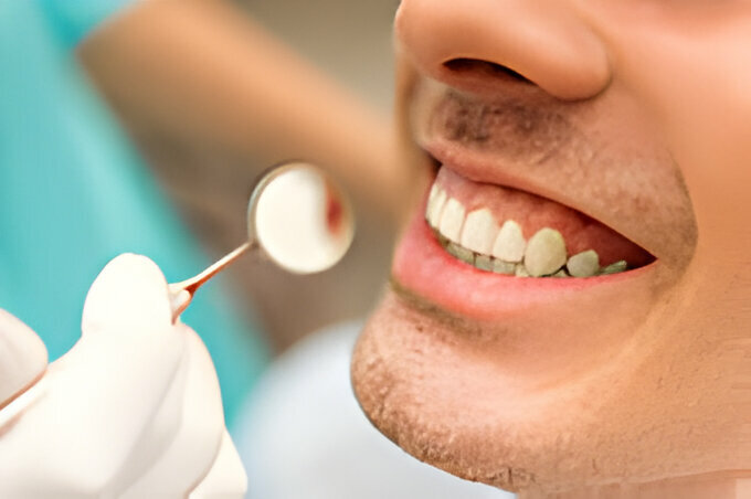 Busting Myths About Dental Cleanings_FI
