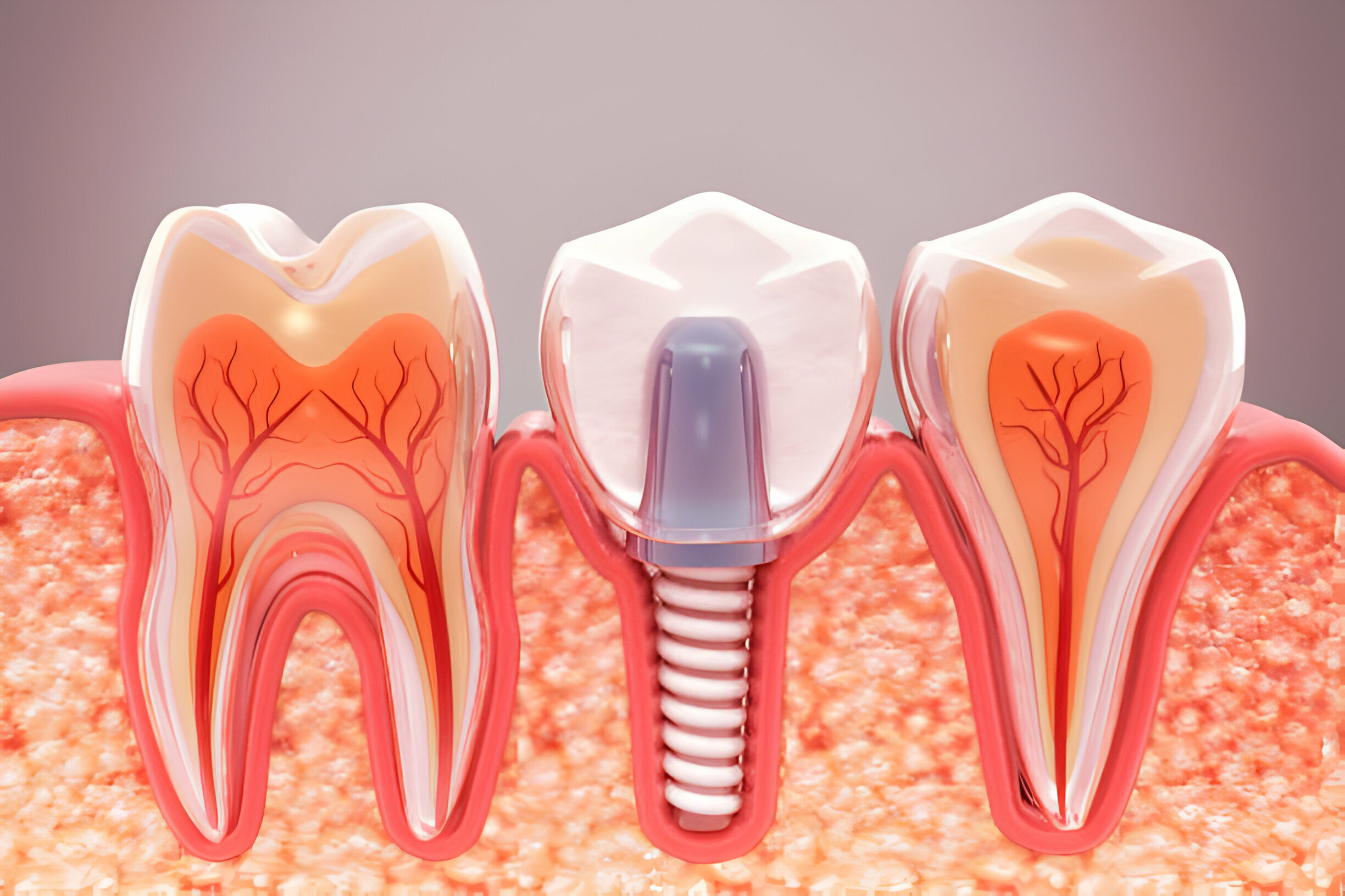 How Dental Implants Can Boost Your Confidence and Quality Of Life?_1