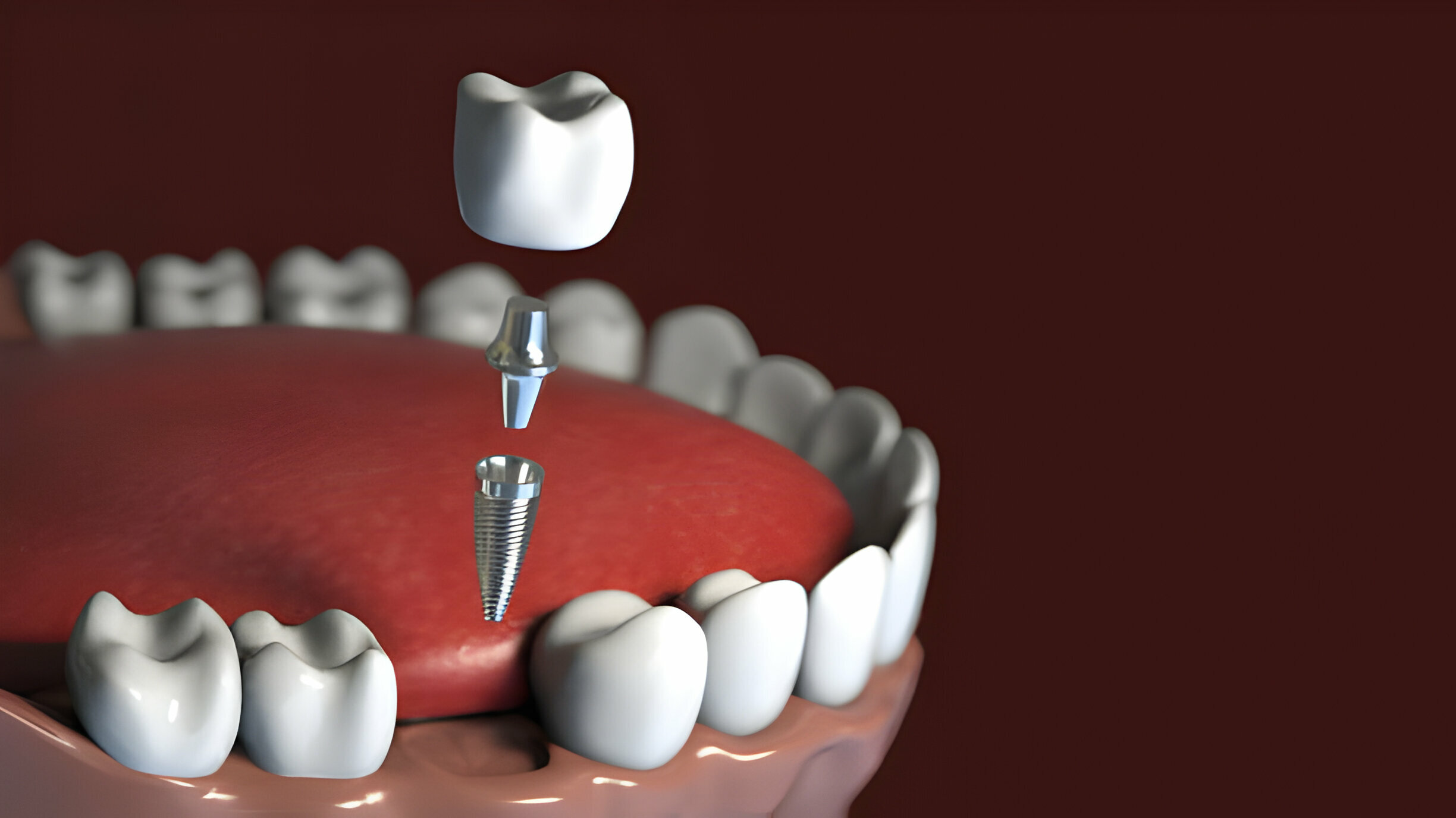 How Dental Implants Can Boost Your Confidence and Quality Of Life?_FI