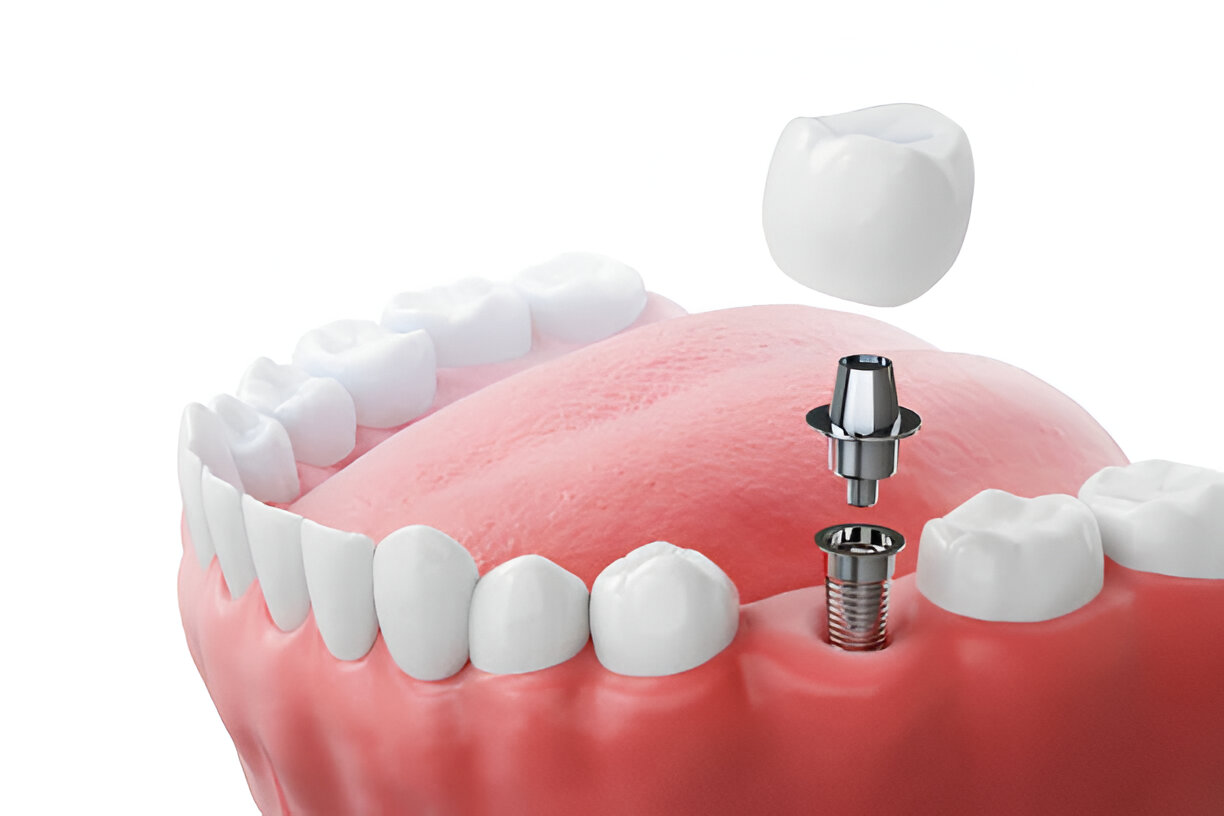 Dental Implants in Summerville, SC: Why Cane Bay Family Dentistry Is Your Best Choice_FI