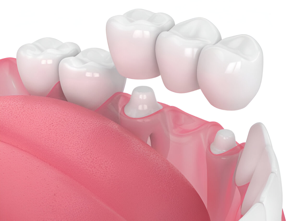 Cane Bay Family Dentistry’s Expert Guide to Types of Crowns for Restorative Dentistry in Summerville, SC_FI