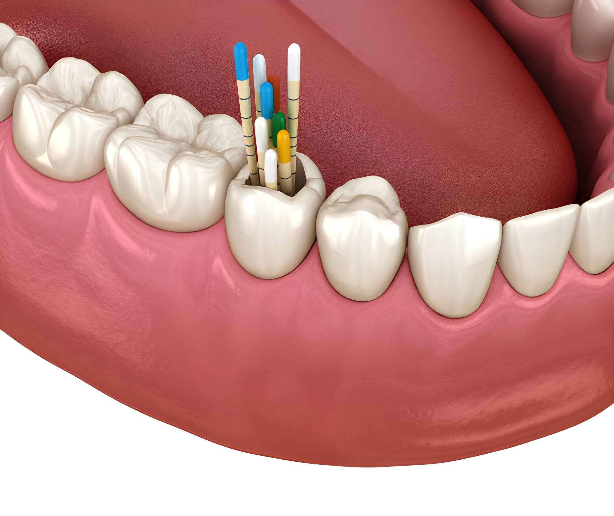 Why Summerville Patients Trust Cane Bay Family Dentistry for Root Canal Therapy_FI